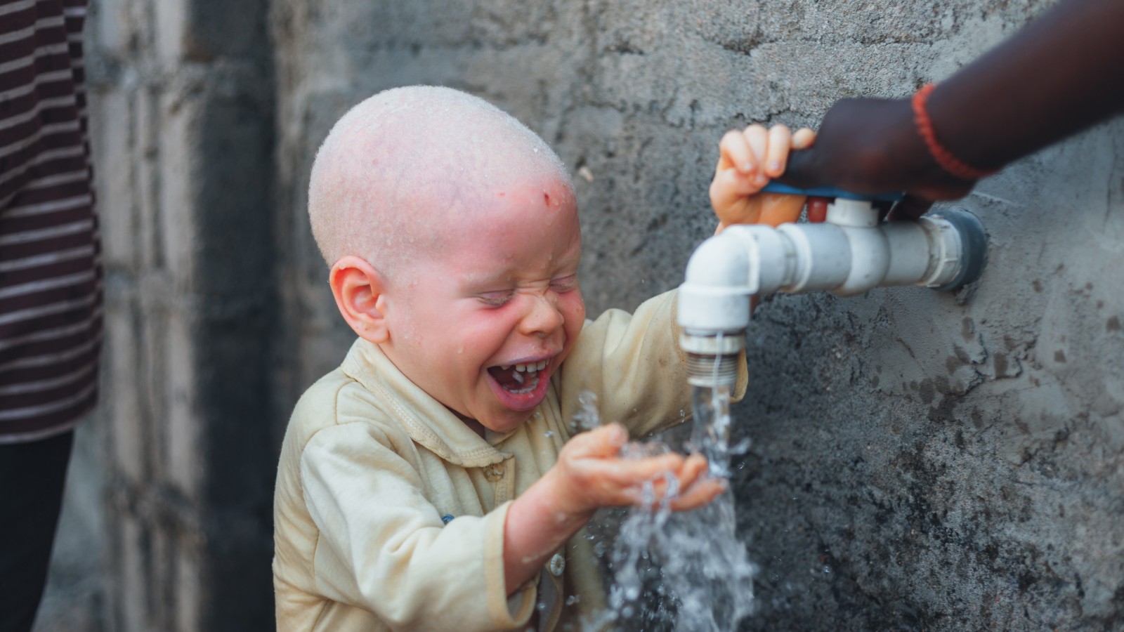 A young child with albinism laughing while washing hands at an outdoor tap